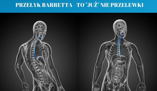 PRZEŁYK BARRETTA – TO “JUŻ” NIE PRZELEWKI